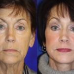 before and after photo of a women who had a facelift and a neck lift