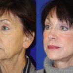 before and after photo of a women who had a facelift and a neck lift