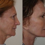 Facelift and Neck Lift before and after