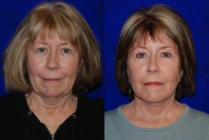 Facelift and Neck Lift before and after