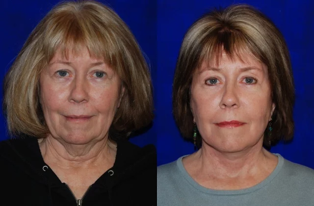 Facelift and Neck Lift before and after