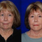 Facelift and Neck Lift before and after