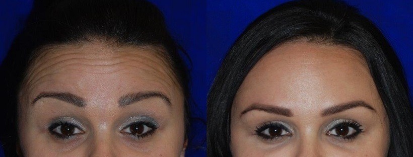 botox before and after face