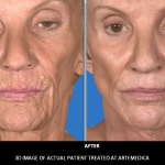 juvederm before and after