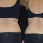 CoolSculpting before and after photos from artemedica in santa rosa