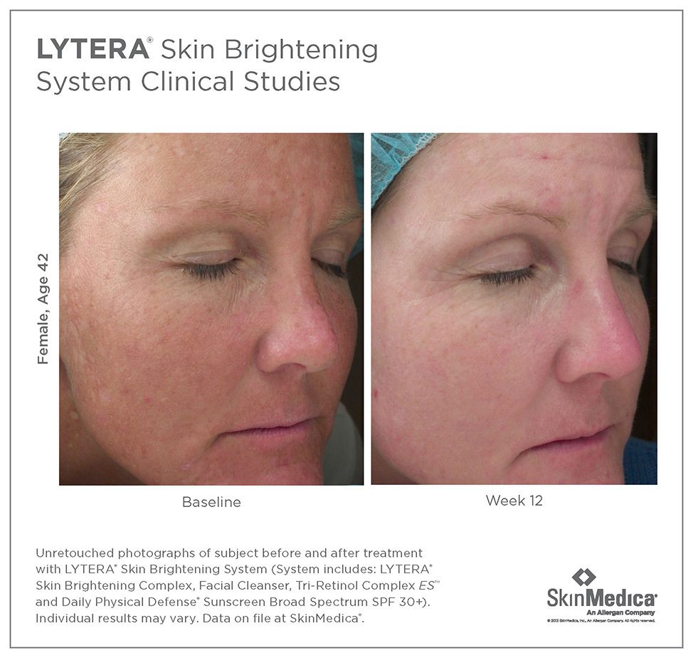 SkinMedica skincare Lytera Skin Brightening Complex clinical studies before and after