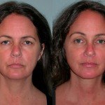 Facelift and Neck Lift before and after