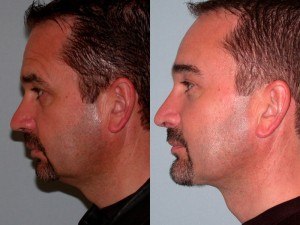 Facelift and Neck Lift before and after