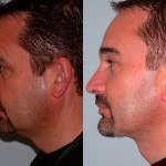 Facelift and Neck Lift before and after on a man