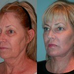 Facelift and Neck Lift before and after