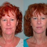 Facelift and Neck Lift before and after