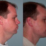 Facelift and Neck Lift before and after