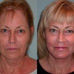 Facelift and Neck Lift before and after