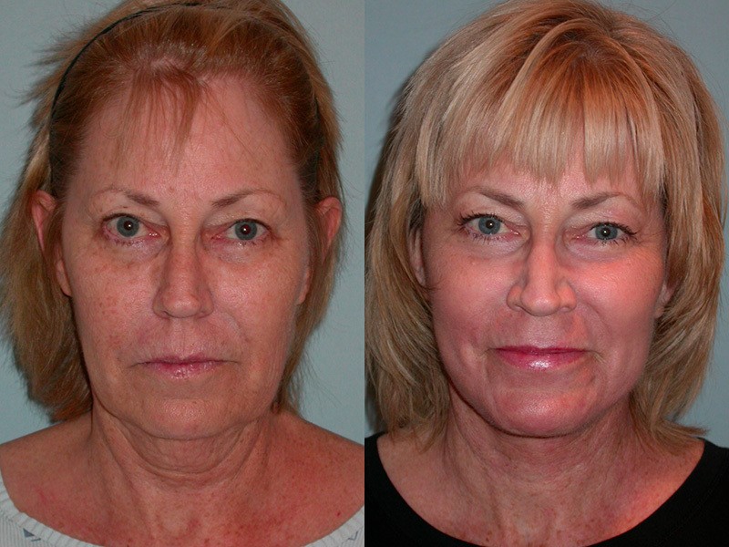 Louis recommends best of Facial laser resurfacing facelift Cassy footjob pictures