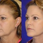 Before and after woman's facelift and neck lift treatment