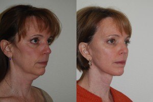 Facelift and Neck Lift before and after