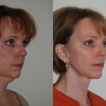 Facelift and Neck Lift before and after Santa Rosa