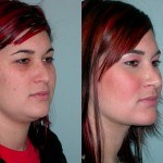 rhinoplasty before and after