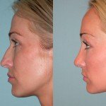 rhinoplasty before and after Santa Rosa