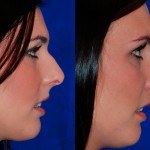 rhinoplasty before and after