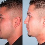 rhinoplasty before and after