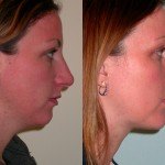 rhinoplasty before and after