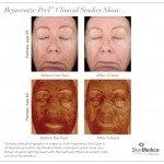 SkinMedica skincare rejuvenize chemical peel series clinical studies before and after