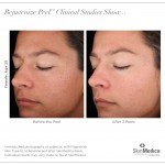 SkinMedica skincare rejuvenize chemical peel series clinical studies before and after