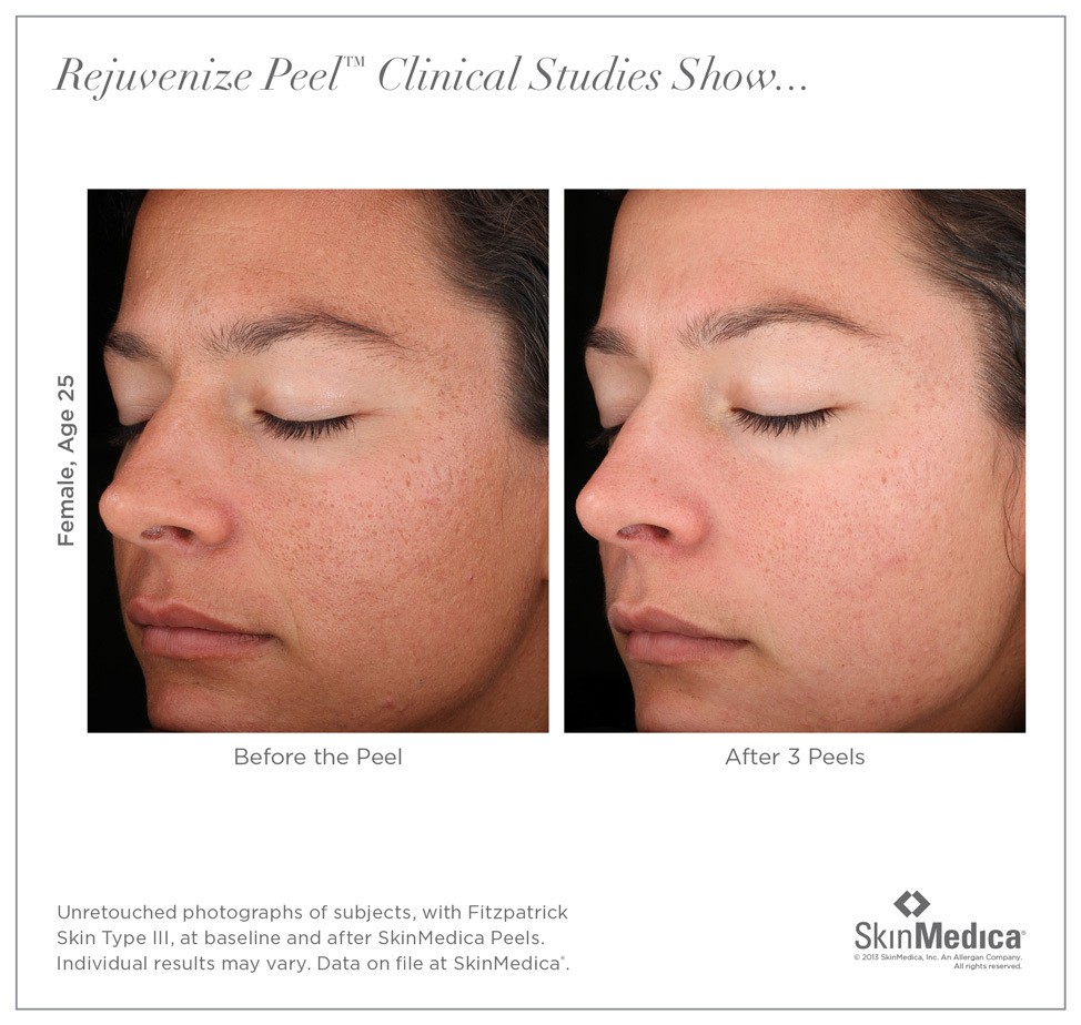 Rejuvenate the Skin You're In With a Chemical Peel - Dontage