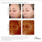 SkinMedica skincare vitalize chemical peel series clinical studies before and after