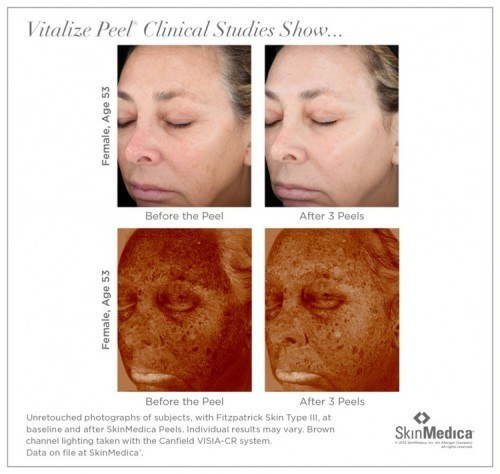 before and after skinmedica revitalize chemical peel