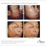 SkinMedica skincare chemical peel series clinical studies before and after