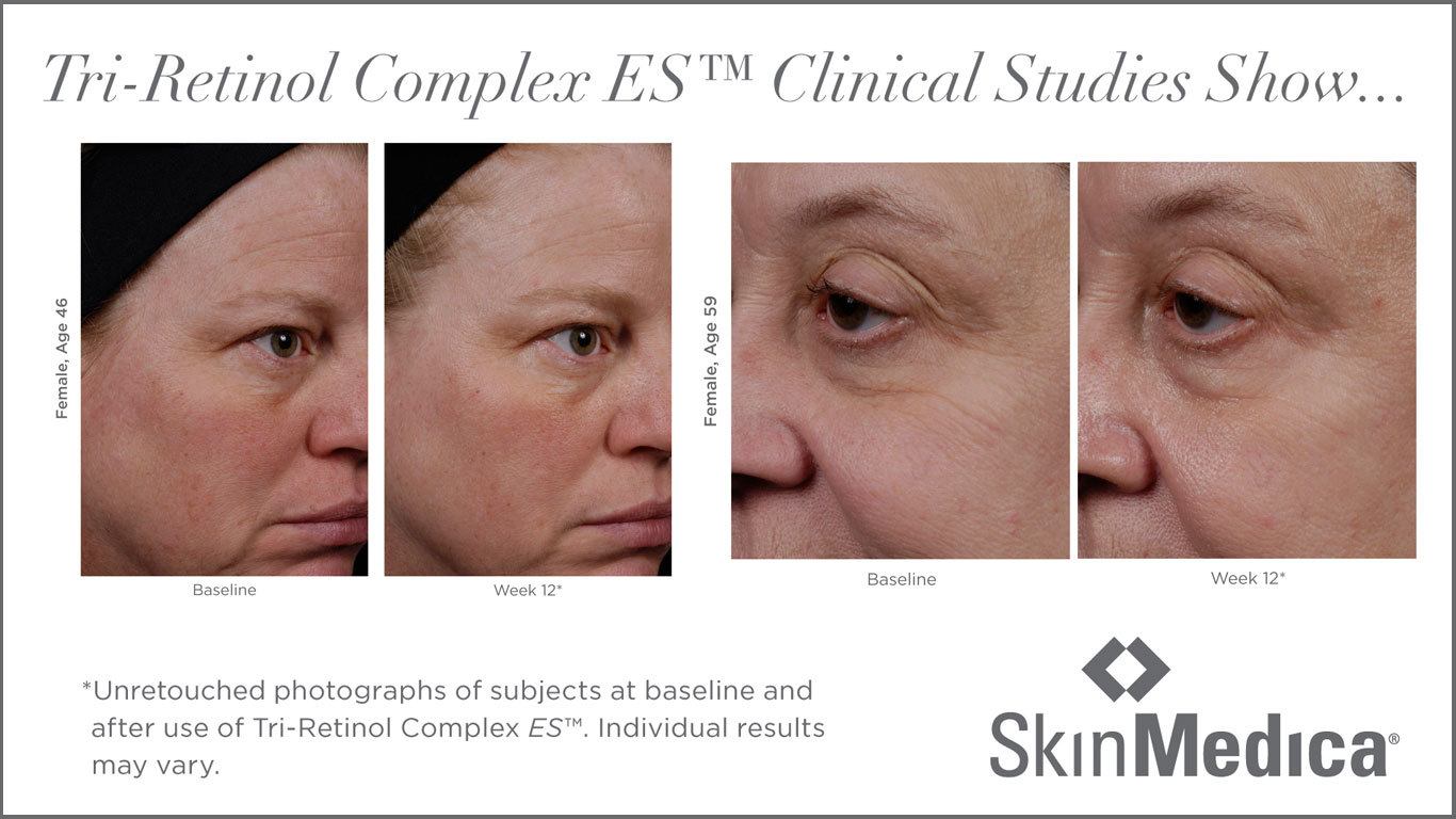 skinmedica skincare tri-retinol complex es clinical studies before and after