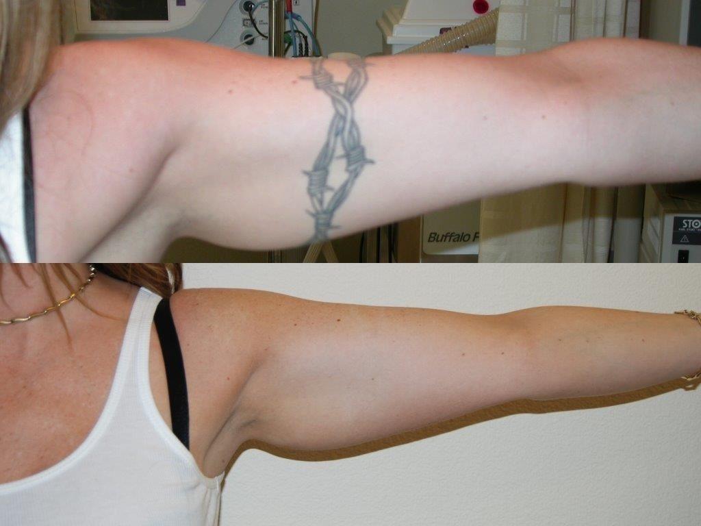 Accelerated Tattoo Removal Treatment - Vanish Laser Clinic Alexandria VA