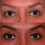 Brow Lift before and after close up
