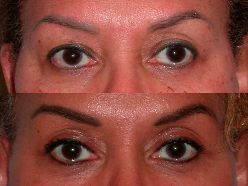 Brow Lift before and after close up