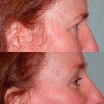 Eyelid Surgery before and after