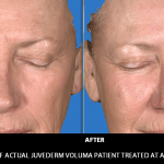 juvederm before and after