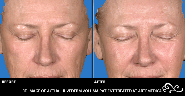 juvederm before and after