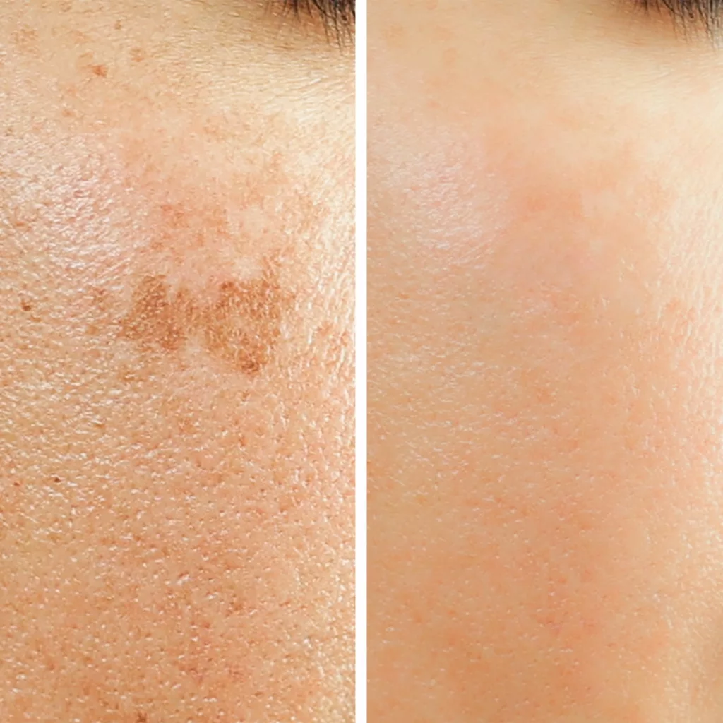 before and after chemical peel to treat hyperpigmentation and uneven skin texture