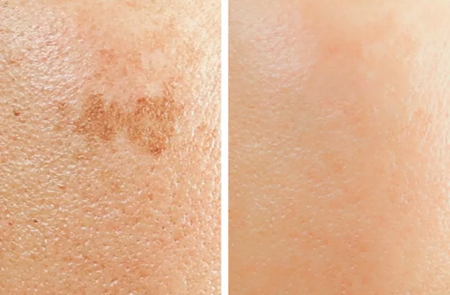 before and after chemical peel to treat hyperpigmentation and uneven skin texture