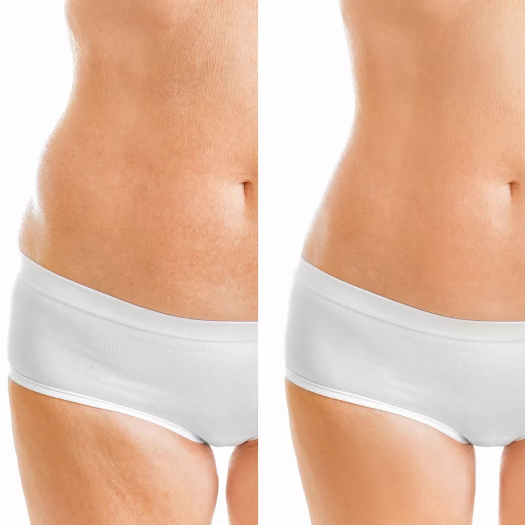 before and after coolsculpting for permanent fat reduction