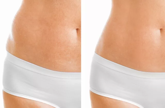 before and after coolsculpting for permanent fat reduction