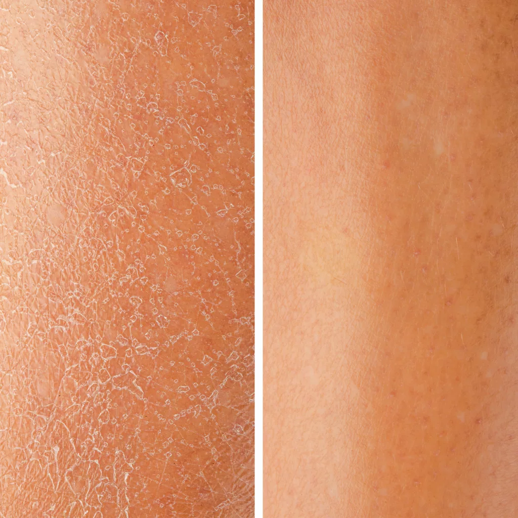before and after professional dermaplaning at a medical spa