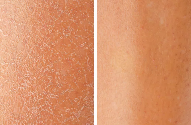 before and after professional dermaplaning at a medical spa