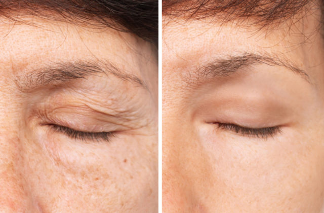 before and after eyelid lift