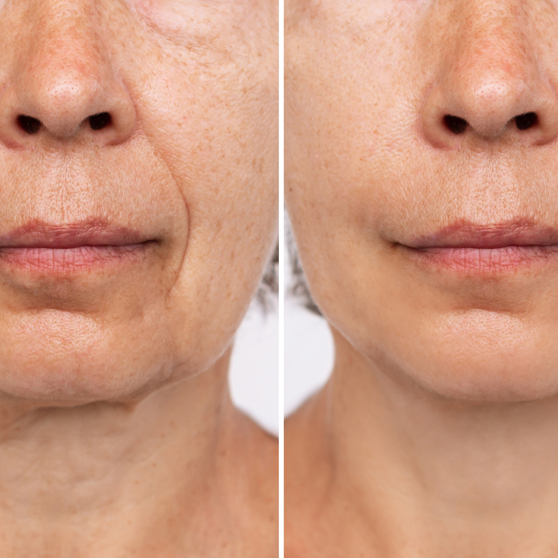 Liquid Facelift with BOTOX and Juvéderm in Santa Rosa