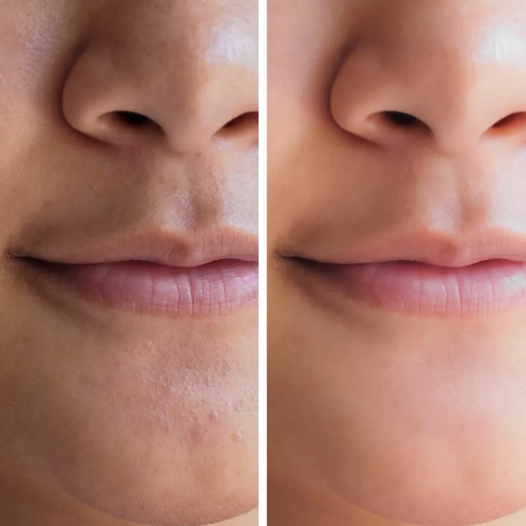 before and after hydrafacial treatment