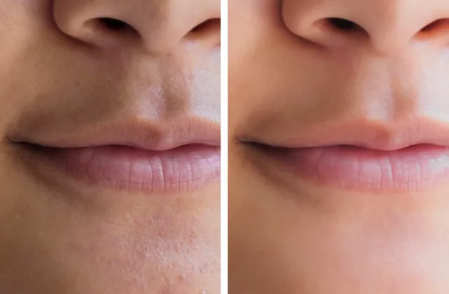 before and after hydrafacial treatment