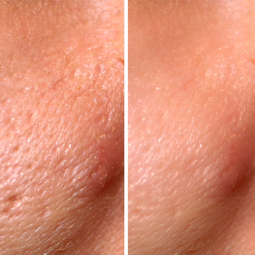 before and after laser resurfacing